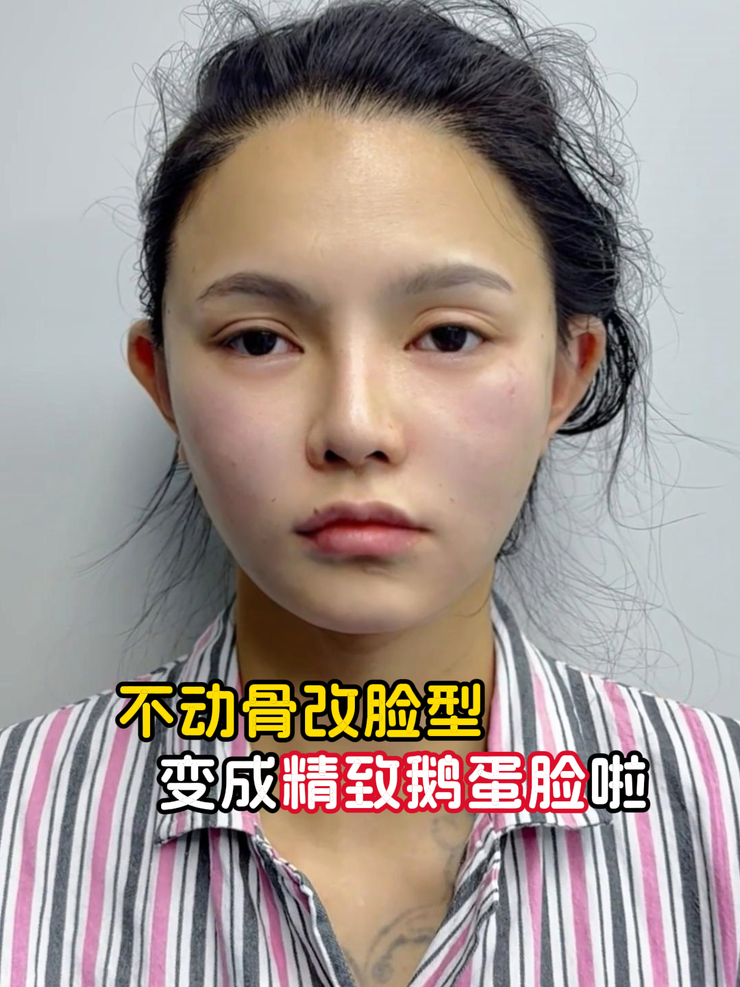 姑娘高颧凸+宽下巴,找沙院不动骨改脸型,1小时变成精致鹅蛋脸!