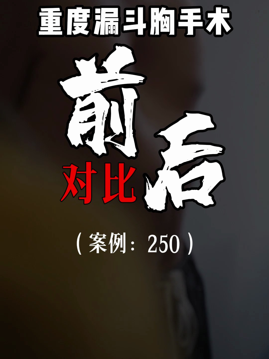 漏斗胸鸡胸医生张东升