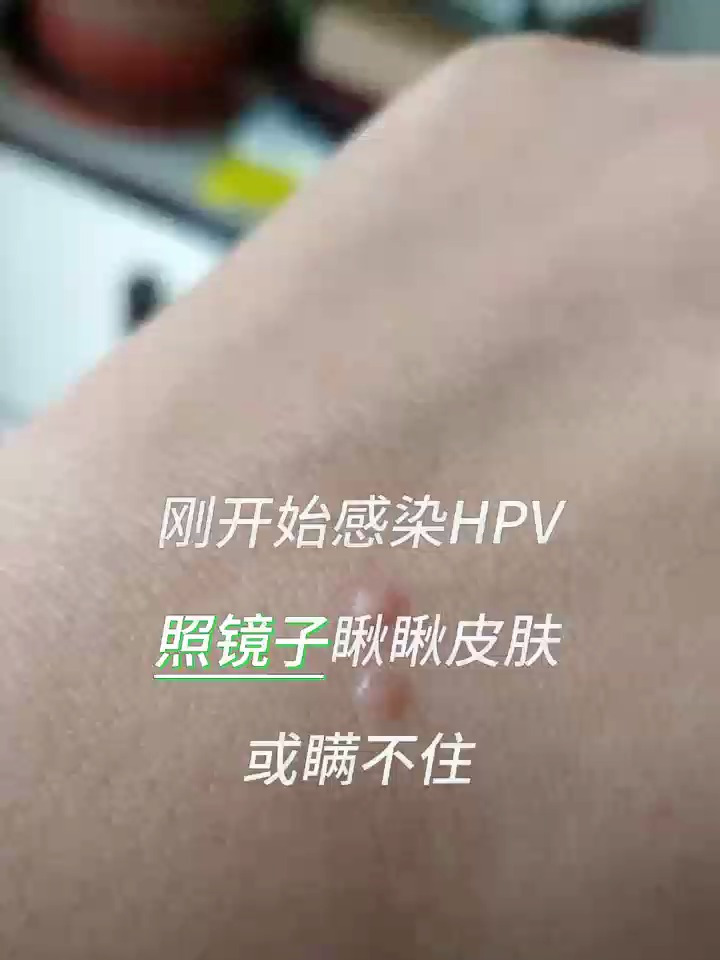 刚开始感染HPV,照镜子瞅瞅皮肤或瞒不住