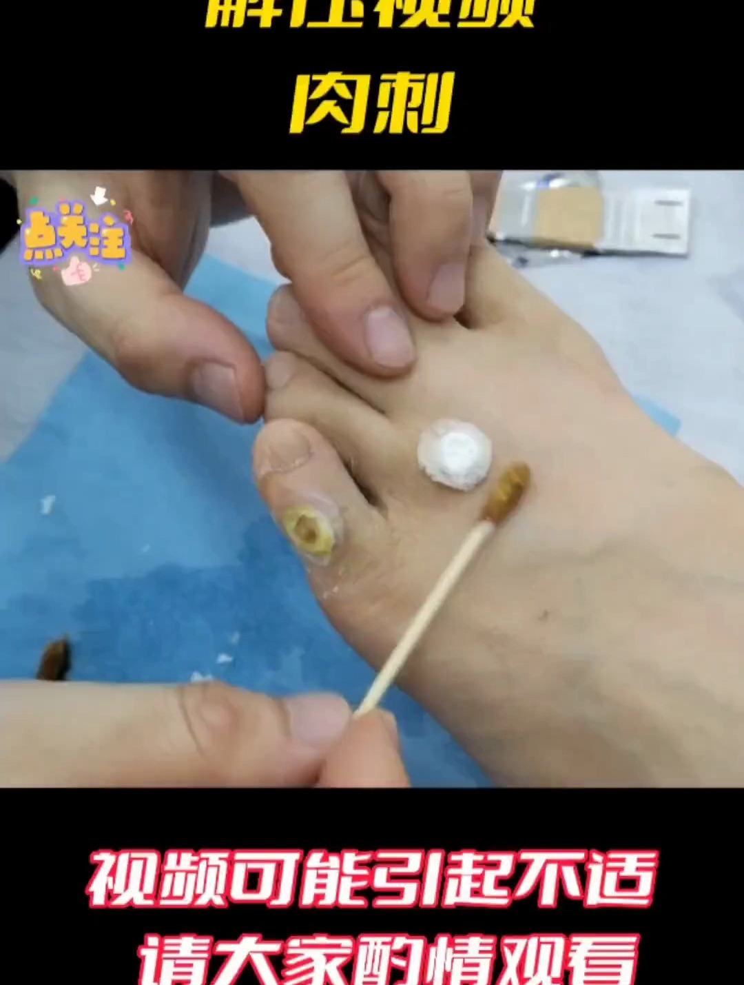 脚上长肉刺鸡眼怎么办,快来看解压