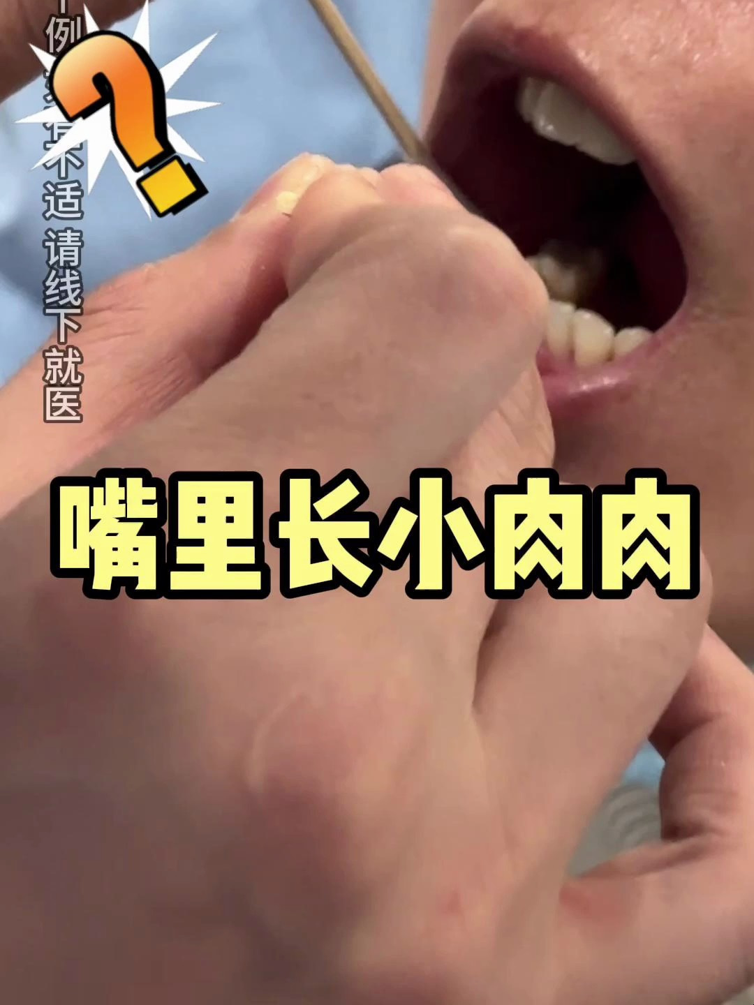 嘴巴上颚有个奇怪的肉肉
