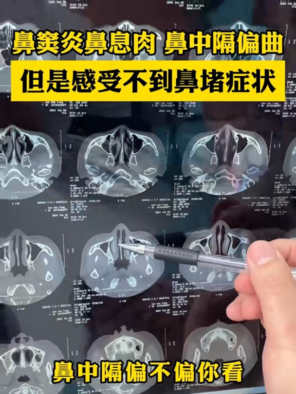 鼻窦炎鼻息肉 鼻中隔偏曲 但是感受不到鼻堵症状