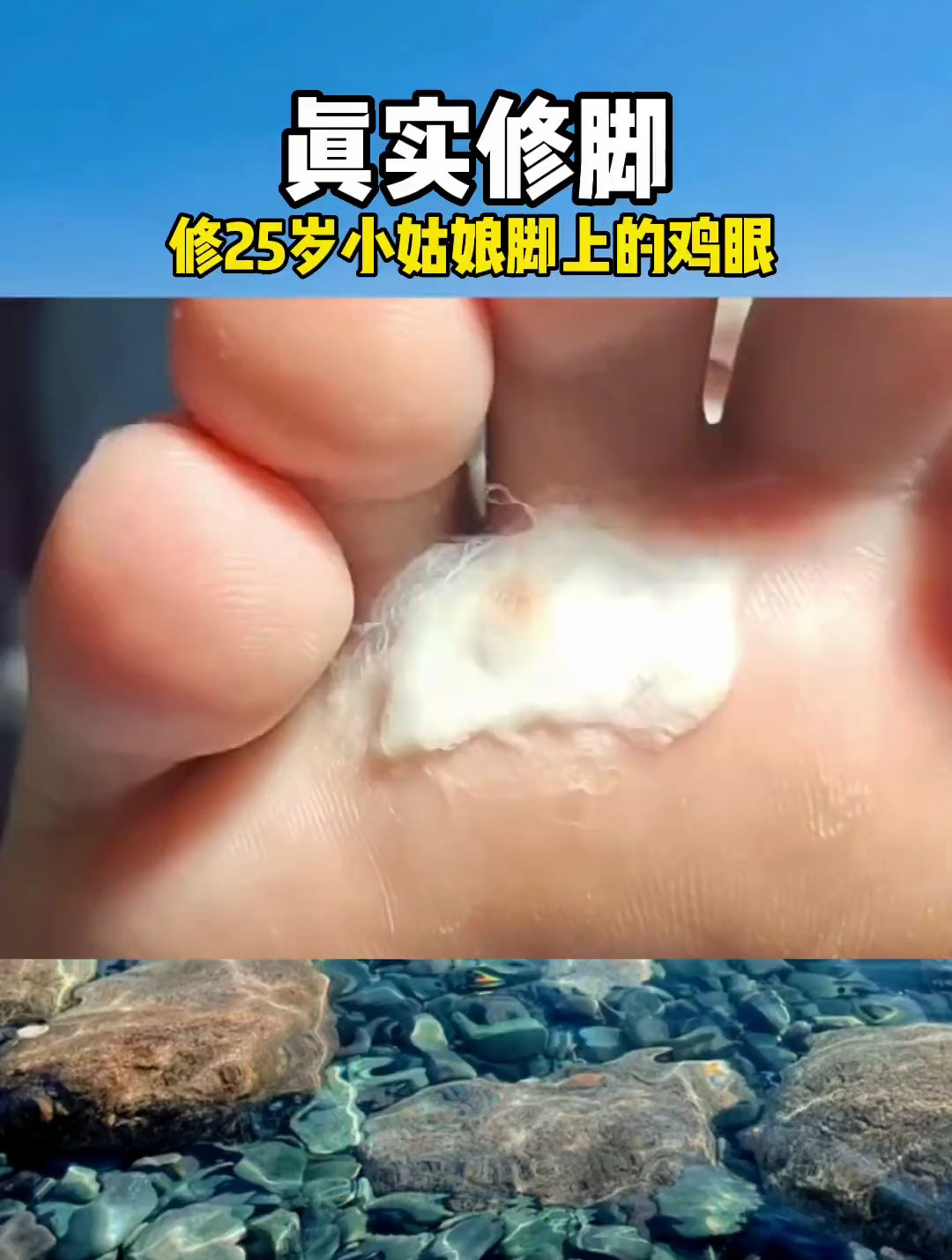 修脚 修脚解压 鸡眼 这个漂亮的小姑娘脚底板生长一棵小鸡眼