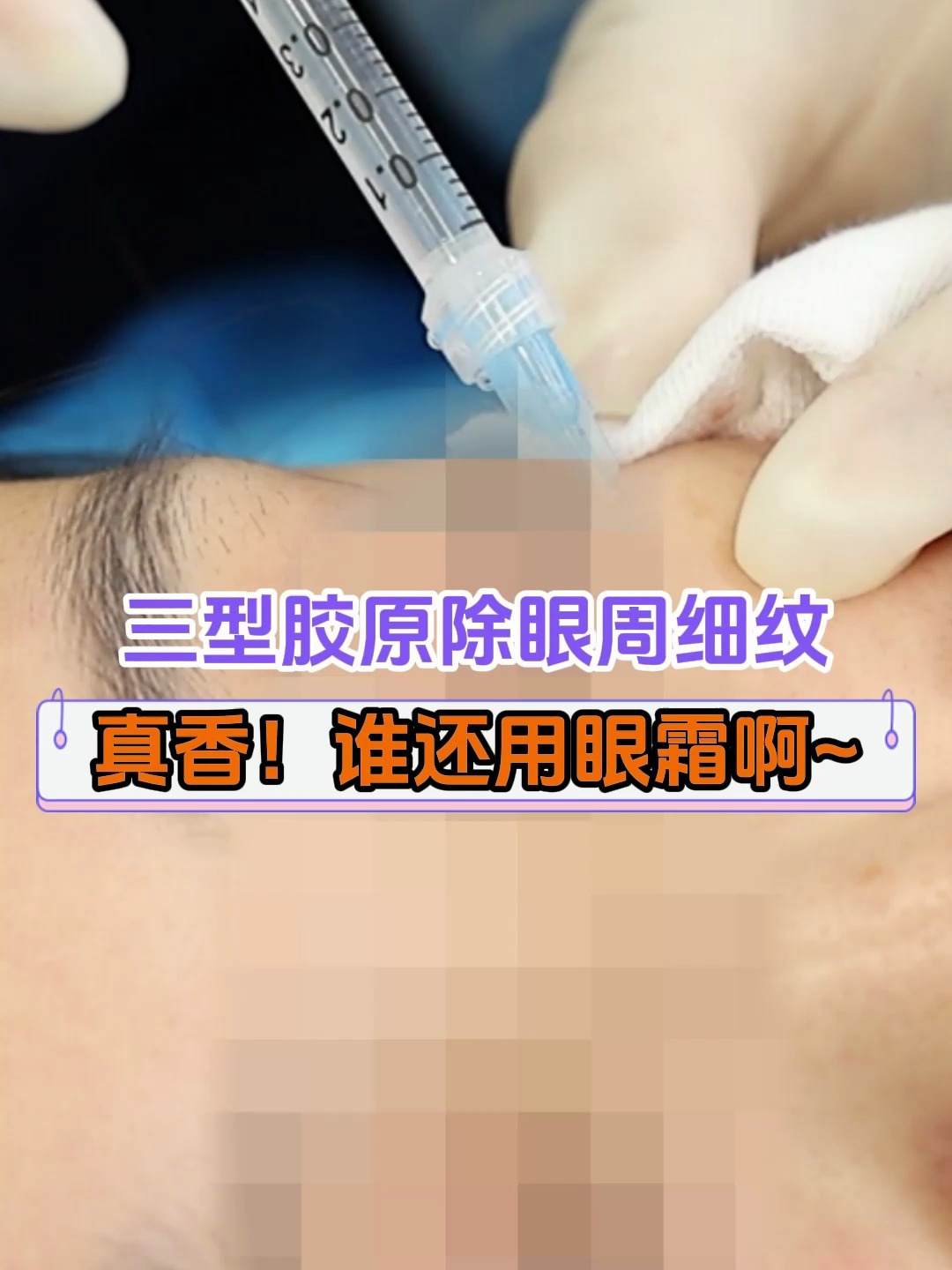 三型胶原蛋白有效改善眼周细纹,别再乱用眼霜了!