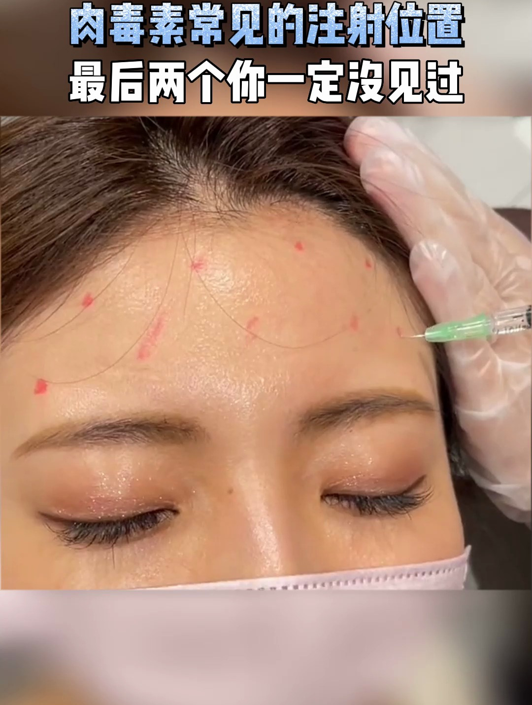 肉毒素常见的注射位置,最后两个你一定没见过