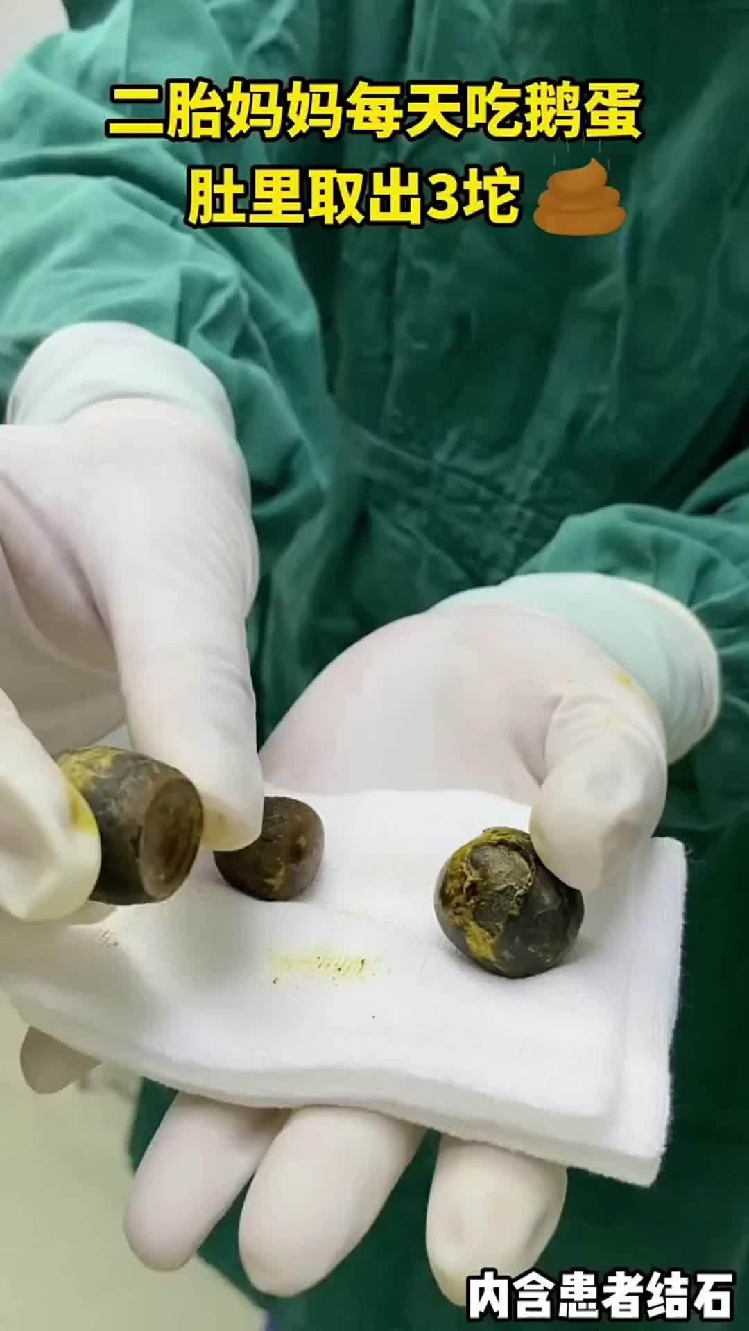 二胎妈妈每天吃鹅蛋,肚子里的结石