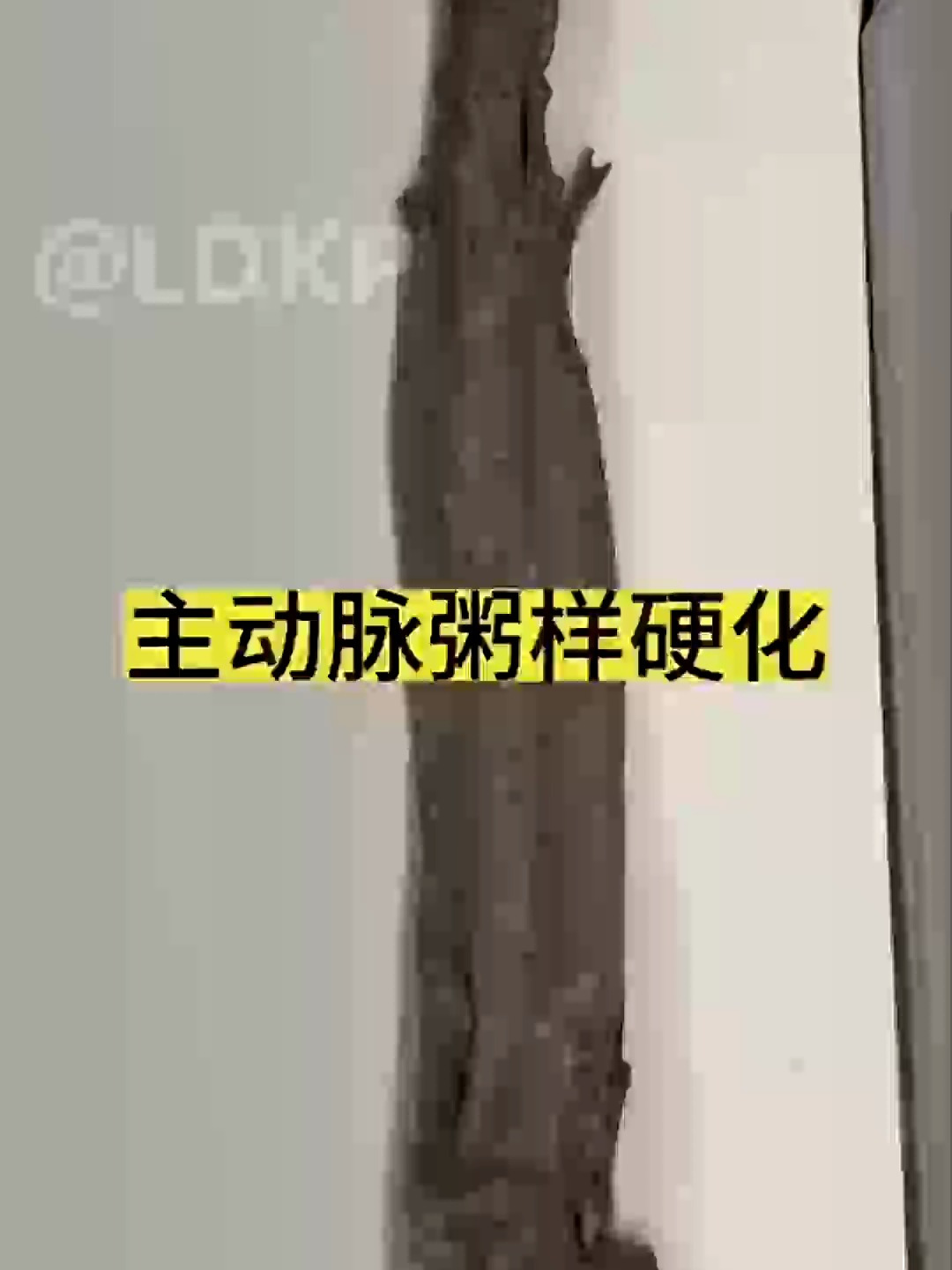 人体标本科普,主动脉粥样硬化标本