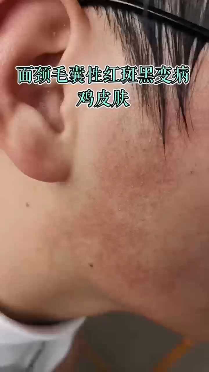 孩子脸上的红斑黑点 这不是普通的鸡皮肤