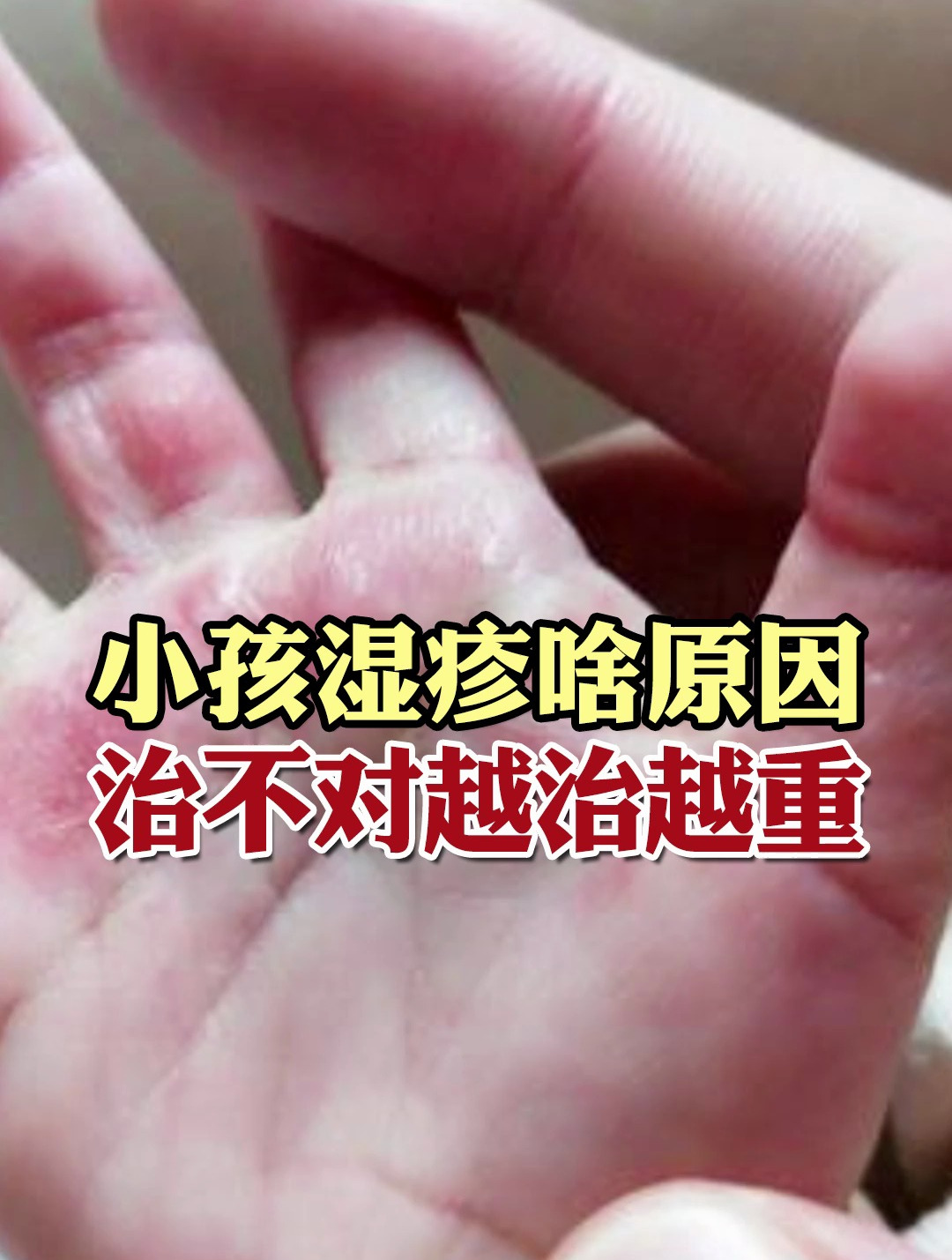小孩湿疹啥原因,治不对越治越重