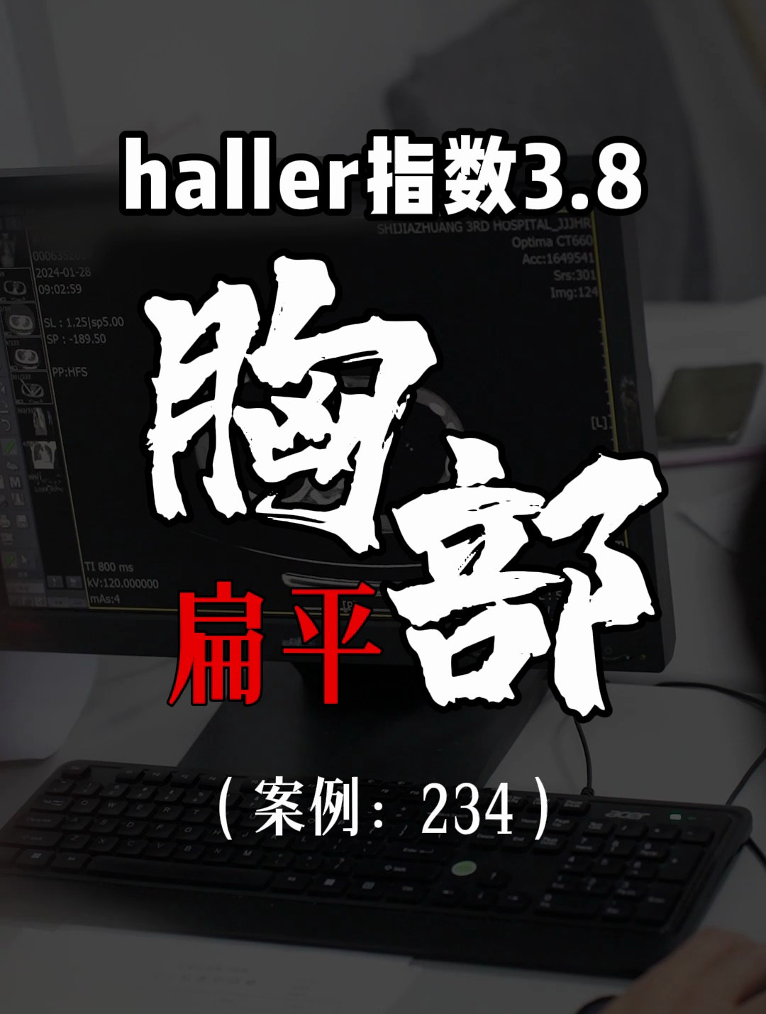 漏斗胸鸡胸医生张东升