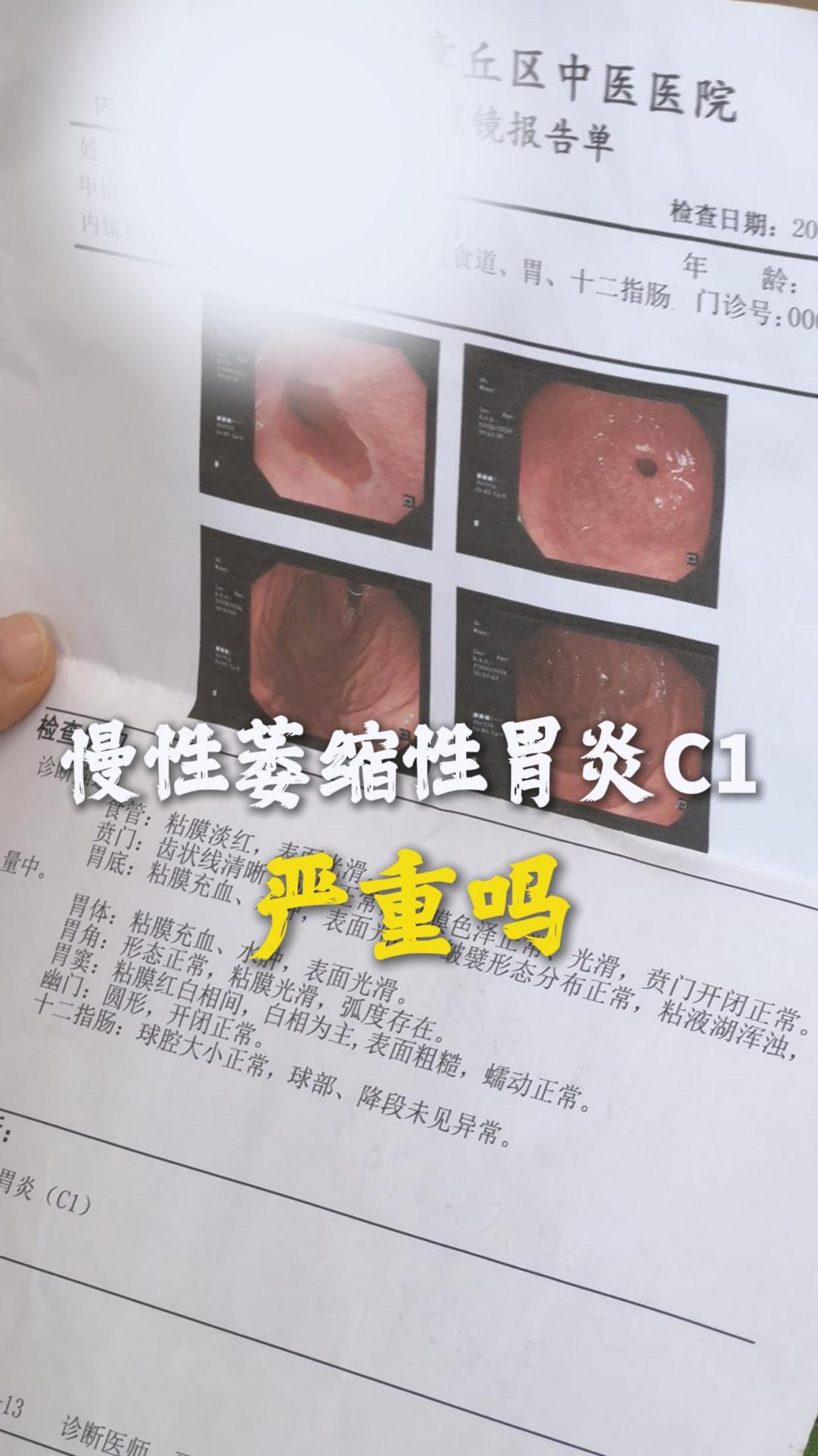 萎缩性胃炎C1严重吗?什么情况才会报 C1、C2、C3呢?
