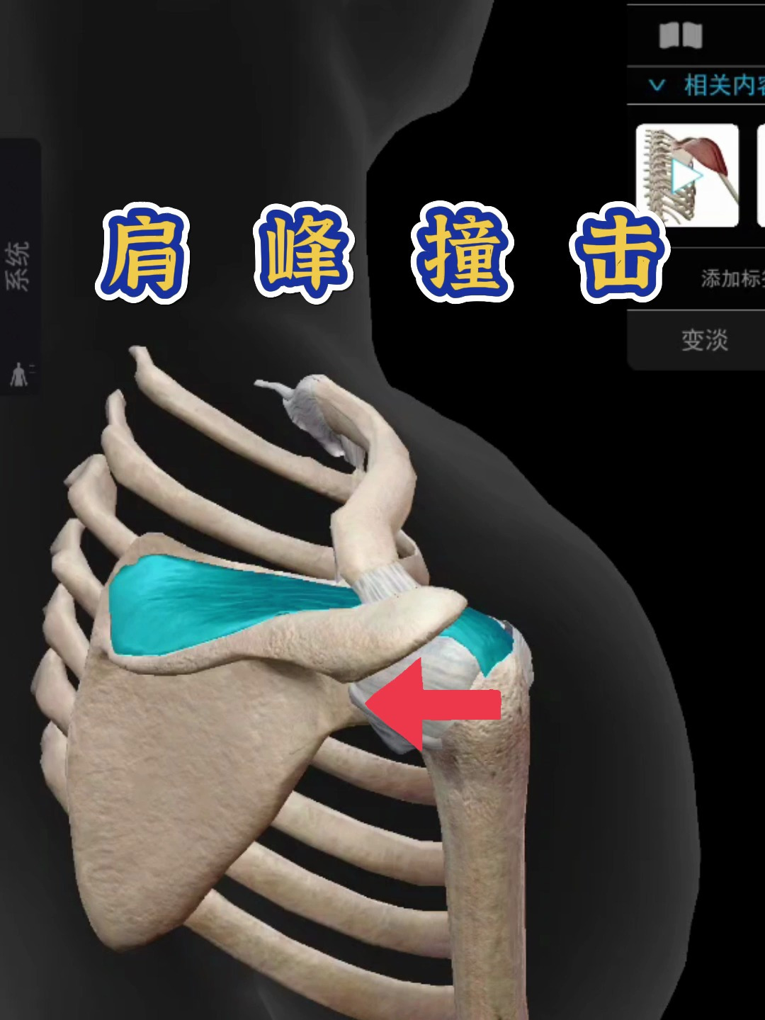 肌肉劳损松解:肩峰撞击是怎么回事呢?