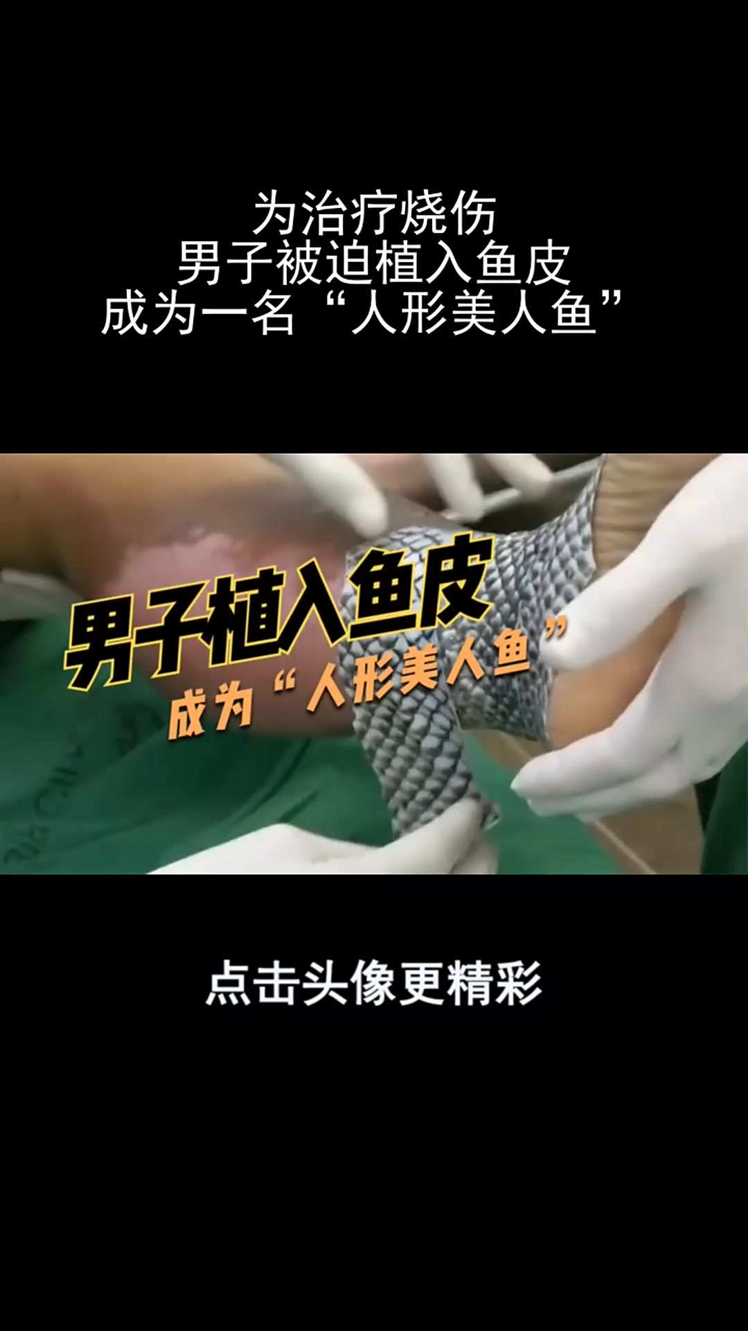 为治疗烧伤,男子被迫植入鱼皮,成为一名“人形美人鱼”!