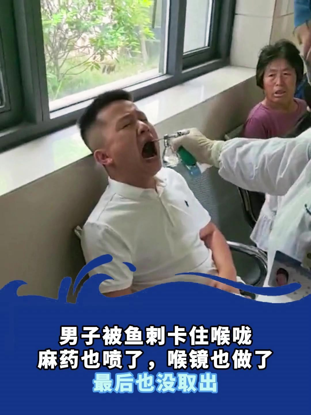男子被鱼刺卡住喉咙,麻药也喷了,喉镜也做了,最后也没取出
