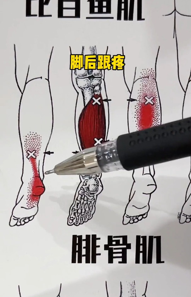 脚后跟不舒服,你可能是比目鱼肌的问题,你可以每天这样放松