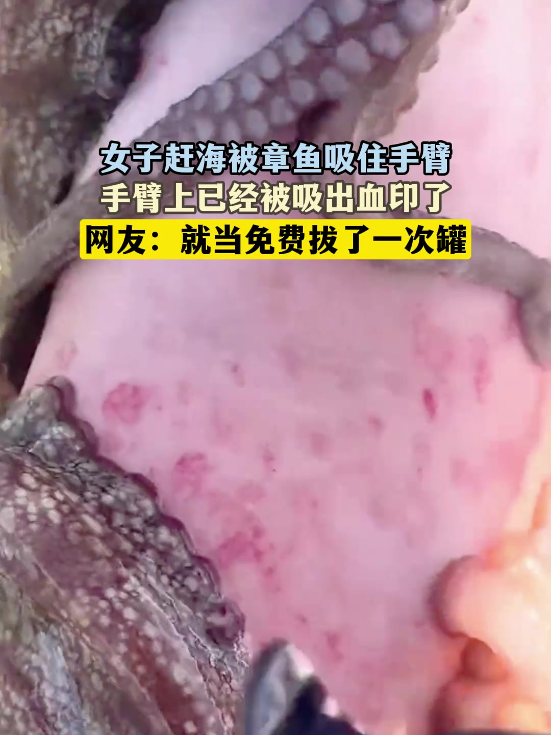 女子赶海被章鱼吸住手臂,手臂上已经被吸出血印了