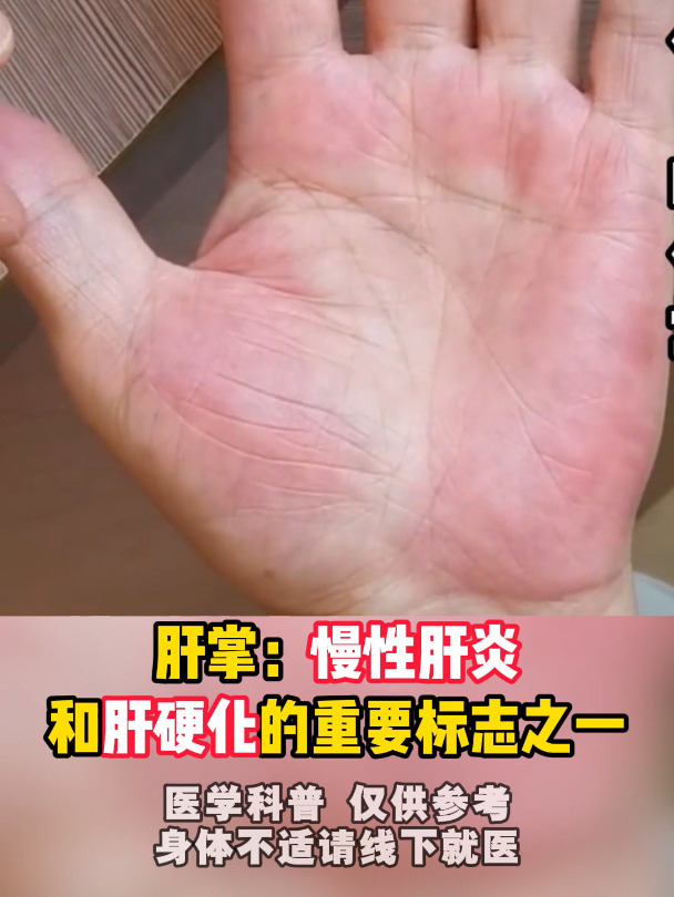 警惕!身边出现这种肝掌可能是疾病信号,务必尽早就医!