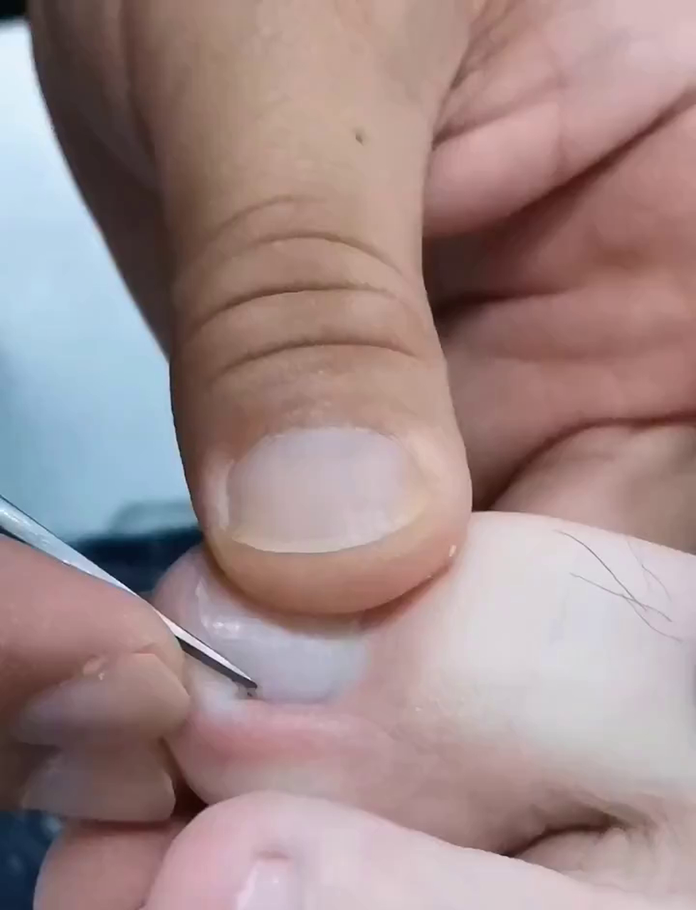 看这视频教你咋整嵌甲,指甲扎肉里了用小工具慢慢修