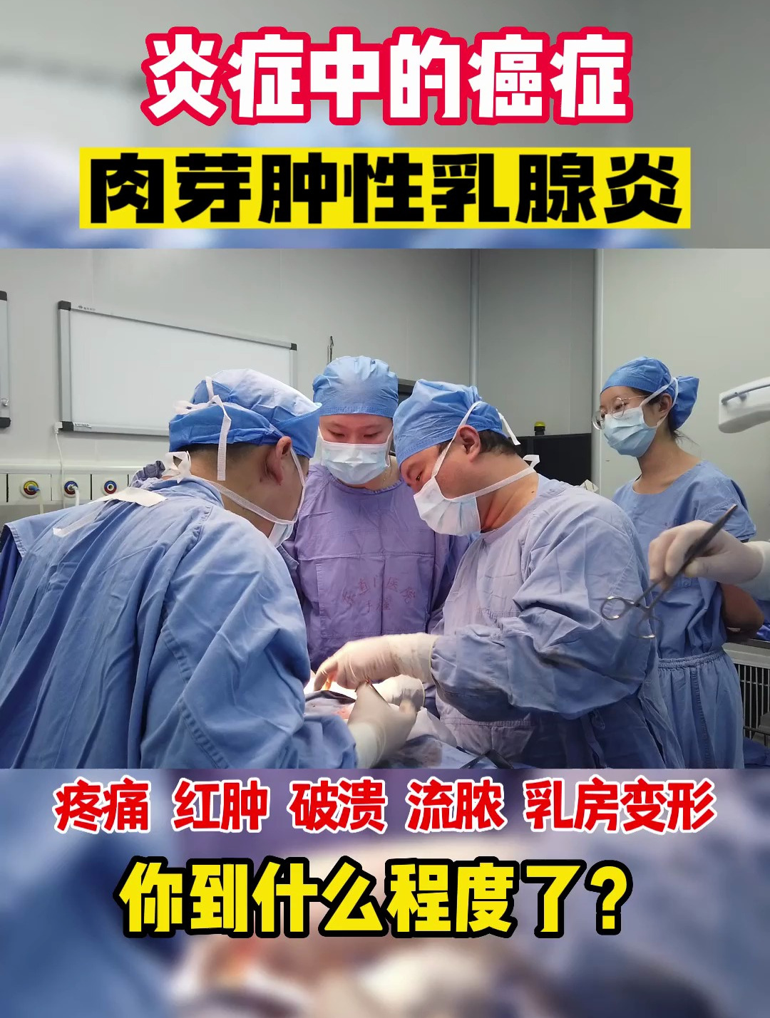 炎症中的癌症,肉芽肿性乳腺炎,你到什么程度了?