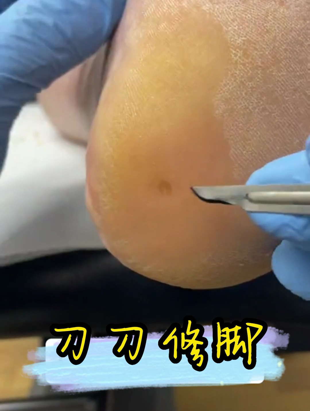 专业修脚,去除脚底鸡眼老茧死皮,超解压