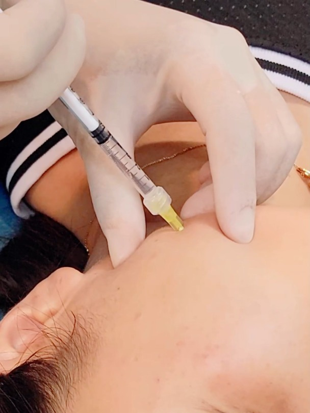 一支肉毒素够不够全脸打?这样分配才合理!