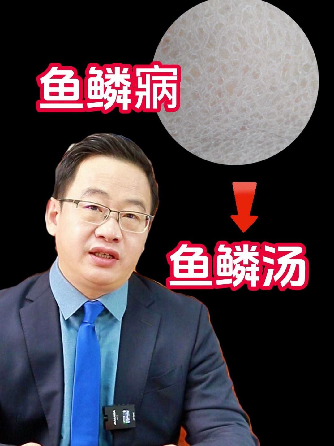 鱼鳞病,就用鱼鳞汤