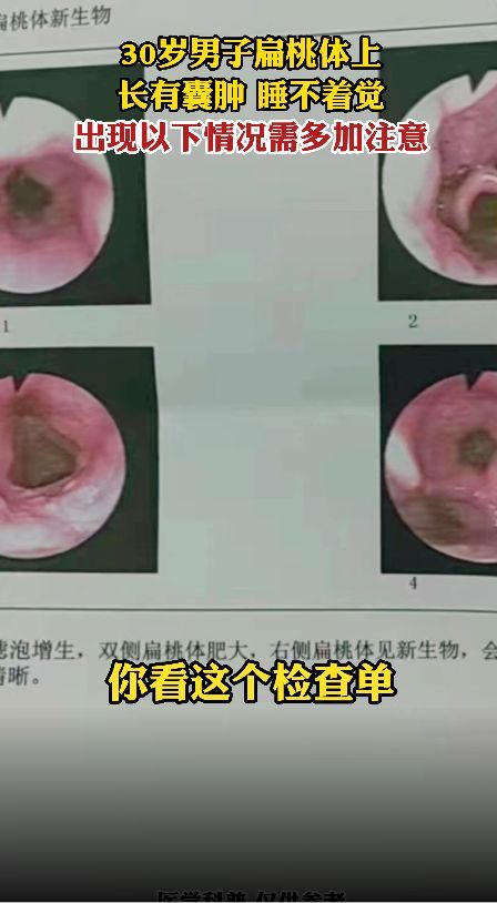 30岁男子扁桃体囊肿,医:出现以下情况要多注意