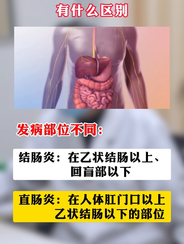 结肠炎和直肠炎有什么区别?
