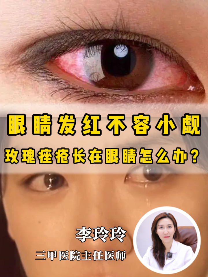 眼睛发红是什么原因引起?如何缓解眼睛发红问题?