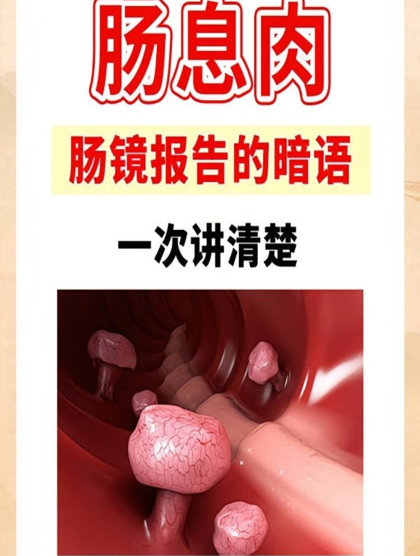一次讲清楚,肠息肉肠镜报告的4个暗语,你知道多少?