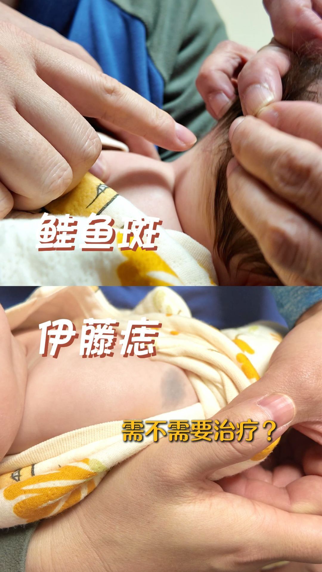 一宝宝,既有鲑鱼斑,又有伊藤痣