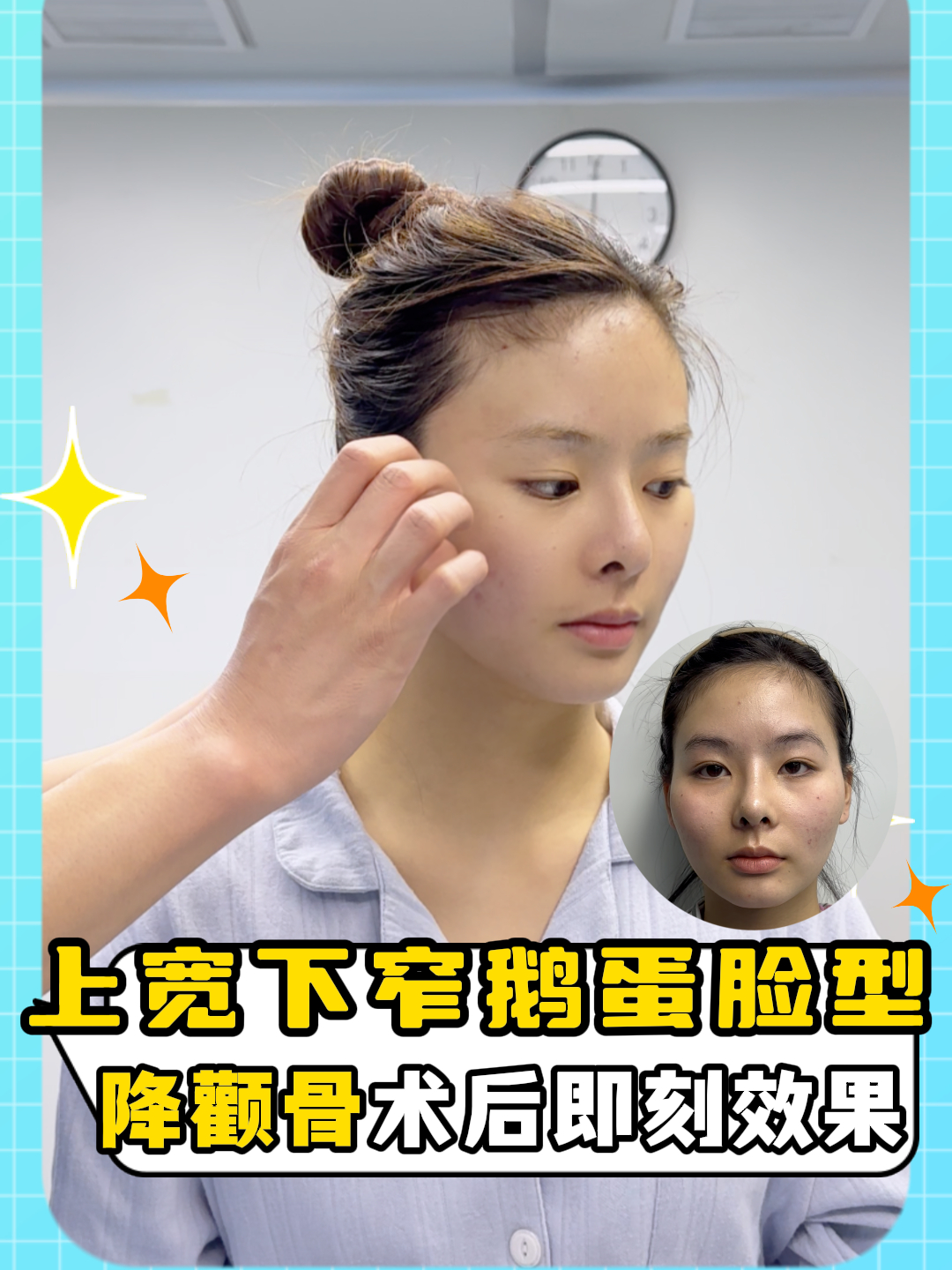 降颧骨术后即刻,上宽下窄鹅蛋脸型,你想拥有吗?