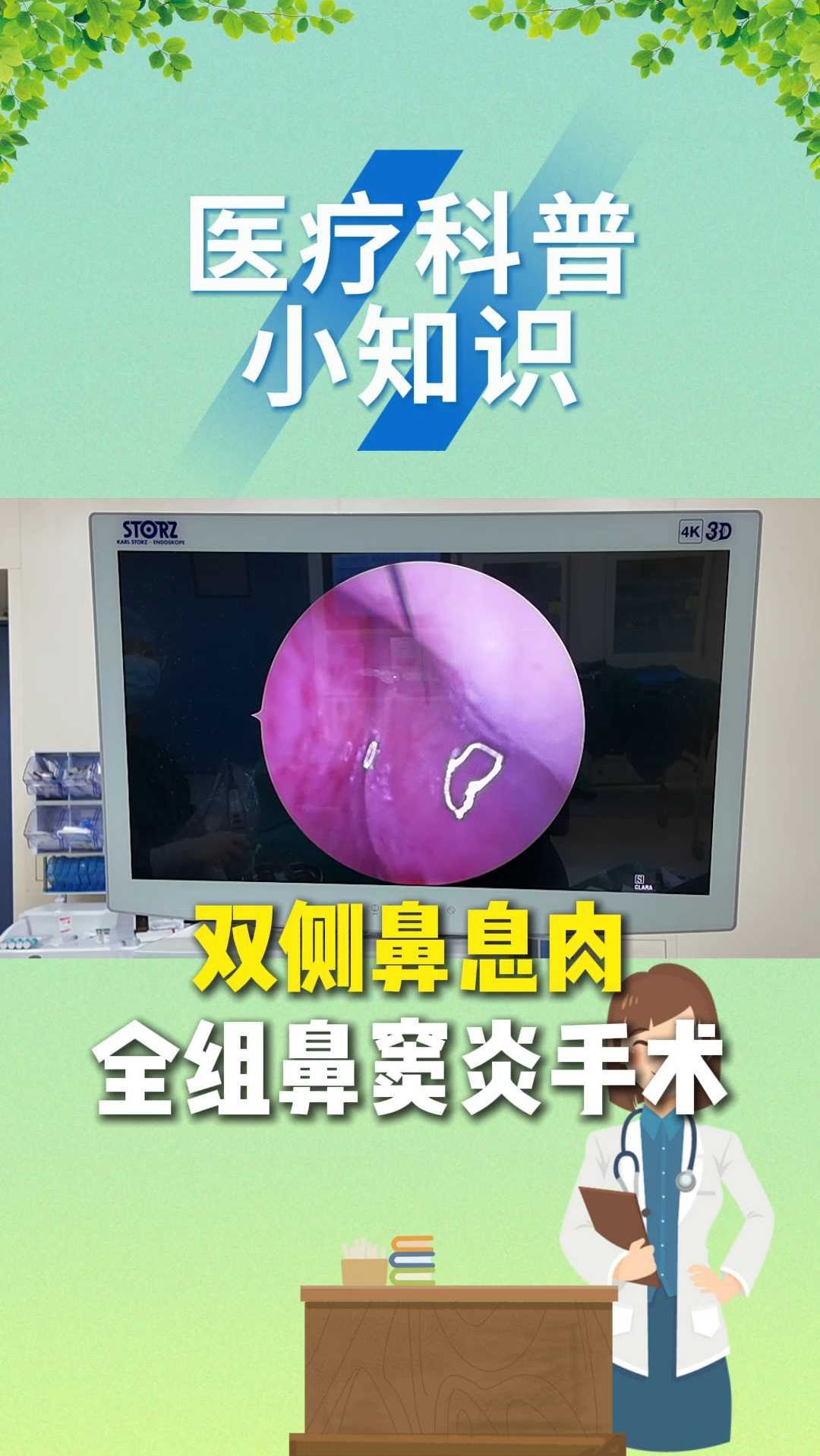 双侧鼻息肉，全组鼻窦炎手术