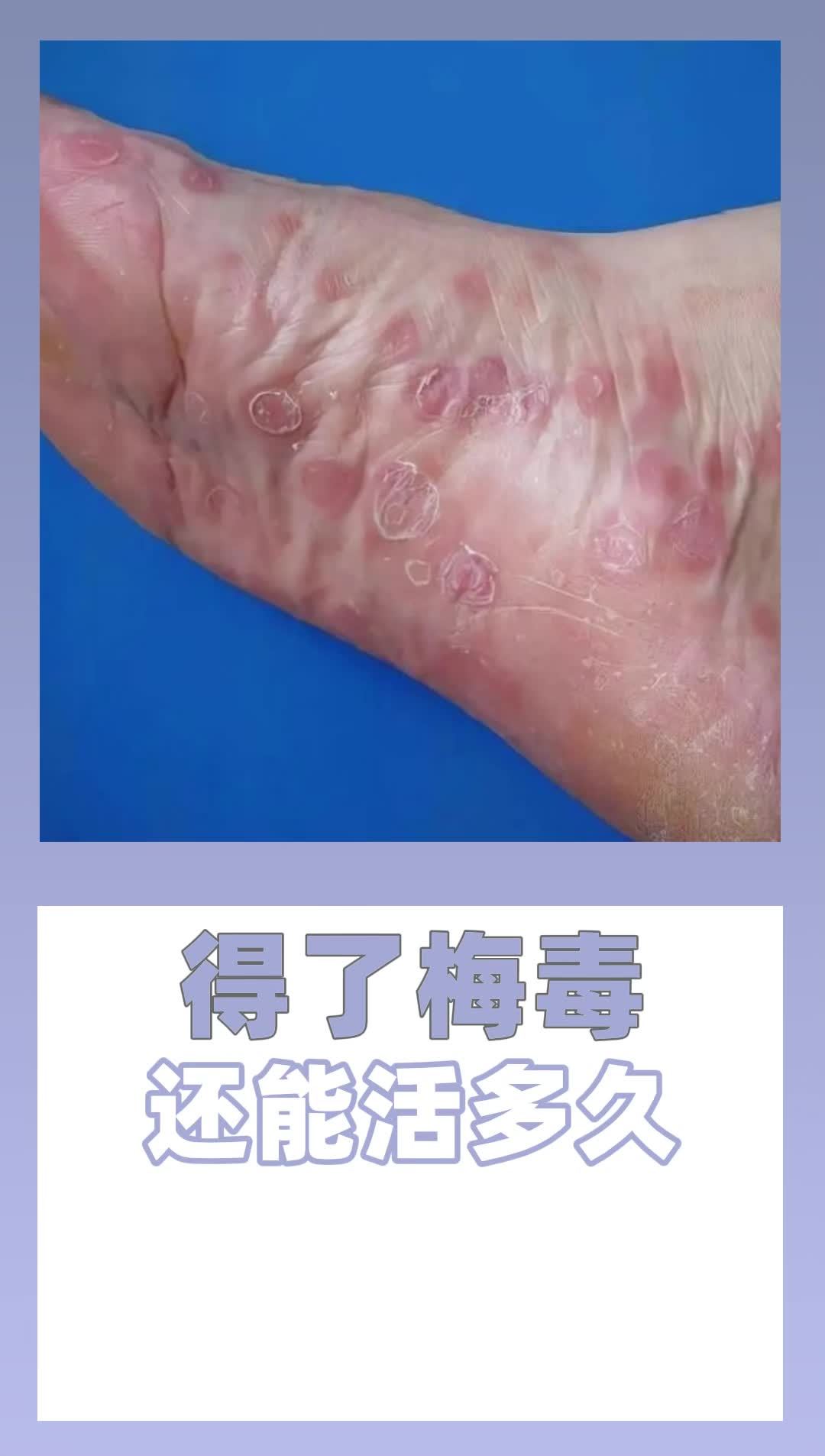 9.13 得了梅毒 还能活多久?(1)