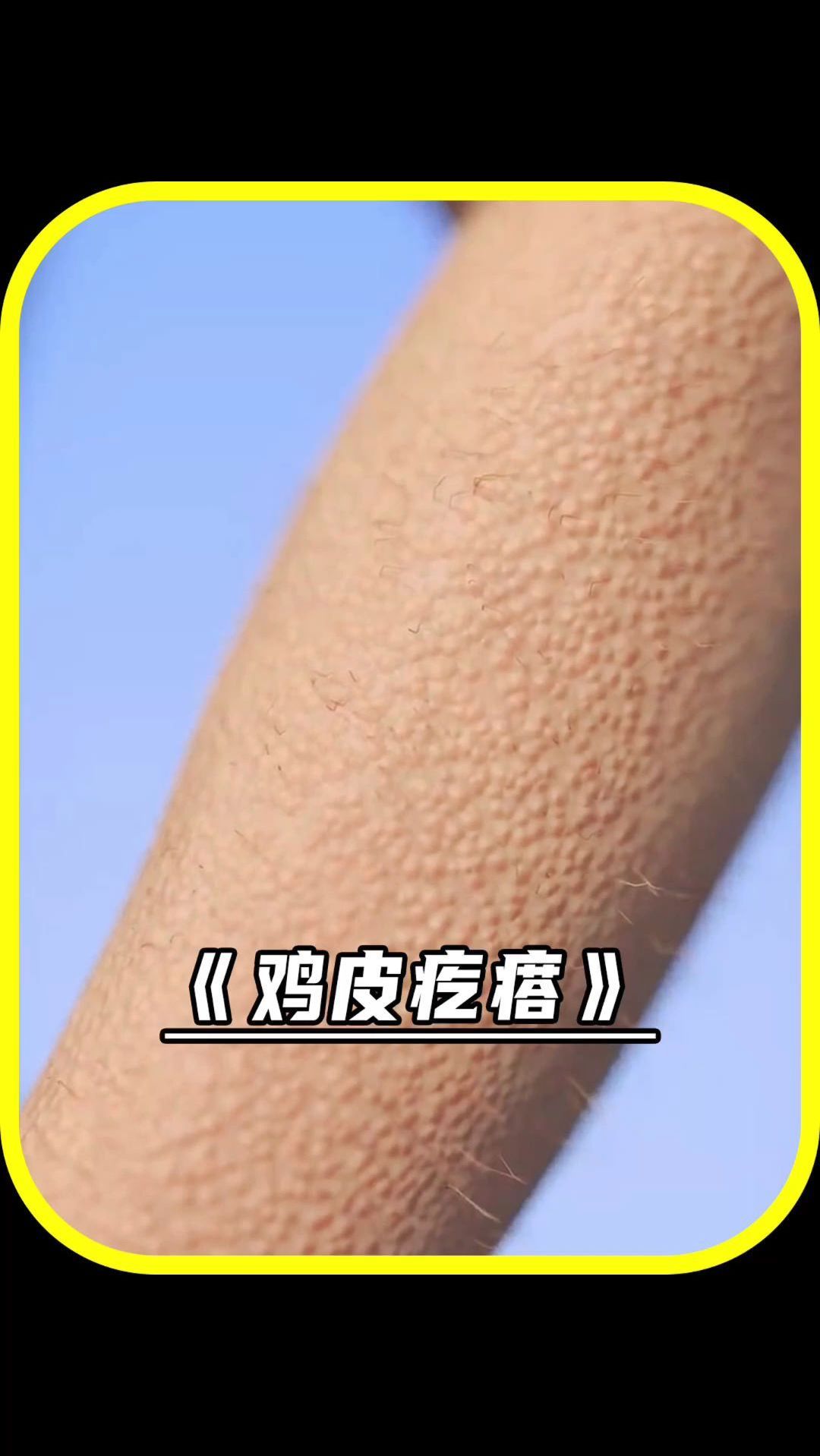 鸡皮疙瘩的产生原因?你一定很好奇吧