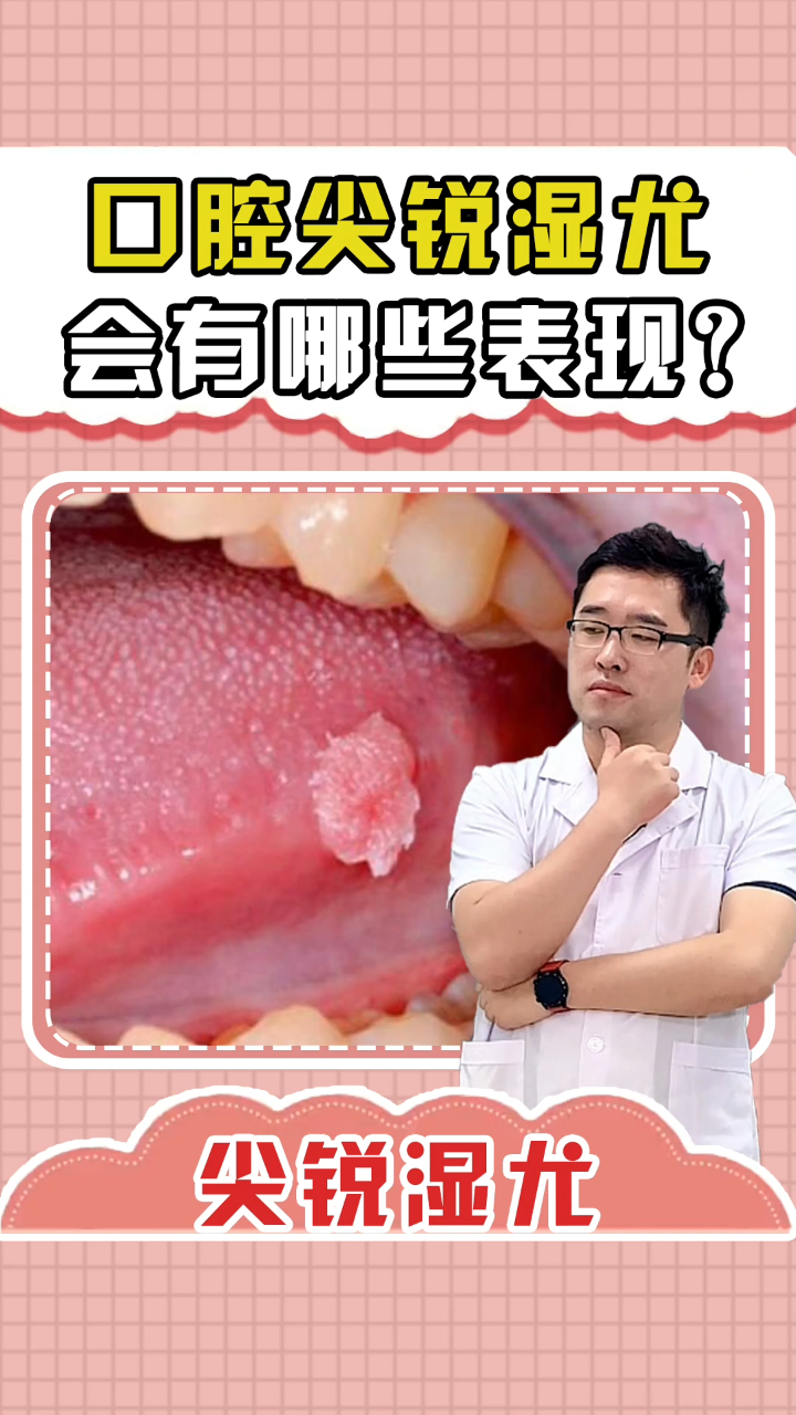 口腔尖锐湿疣会有哪些表现?