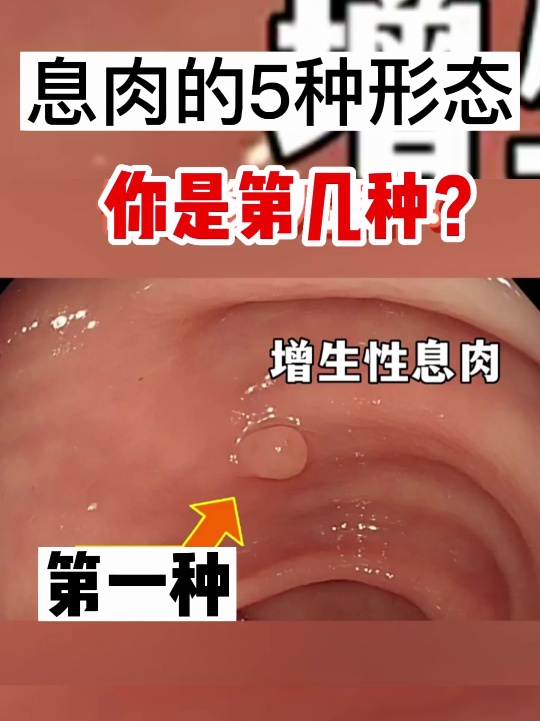 肠息肉的5种形态,看看你是哪一种?