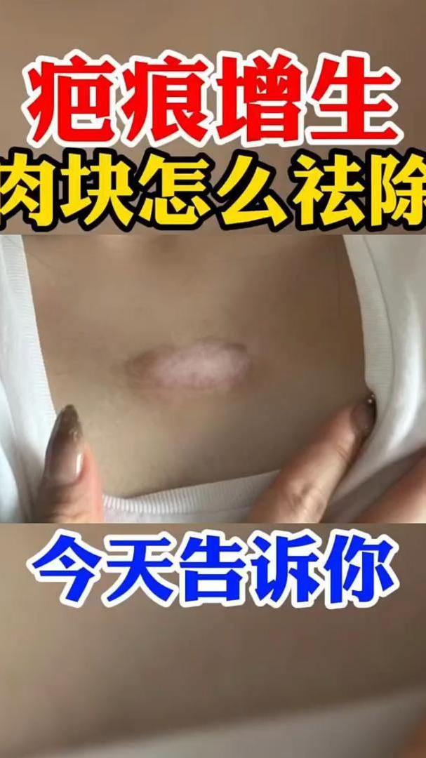 疤痕增生肉块怎么去除?