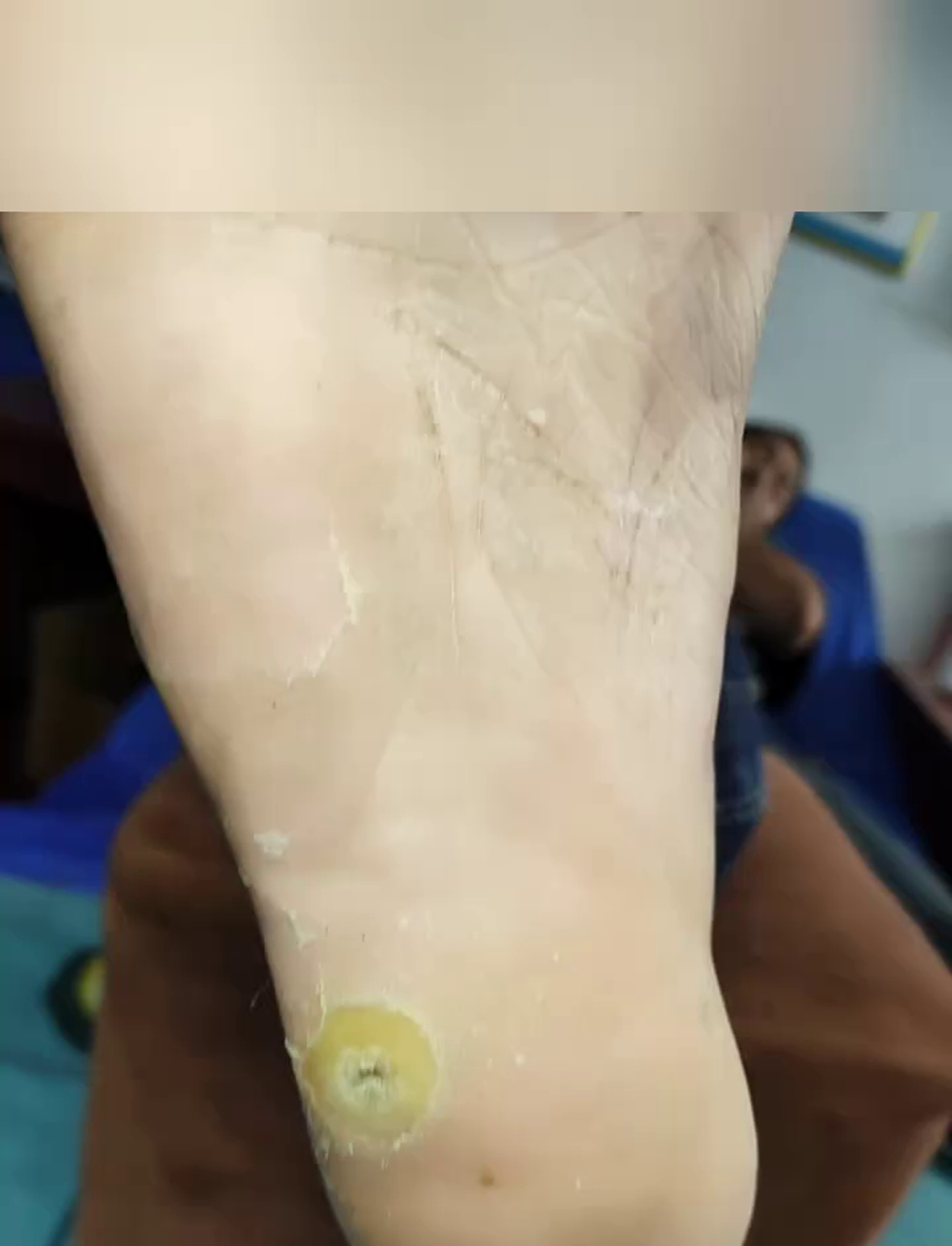 脚上长鸡眼真难受，看着都疼！