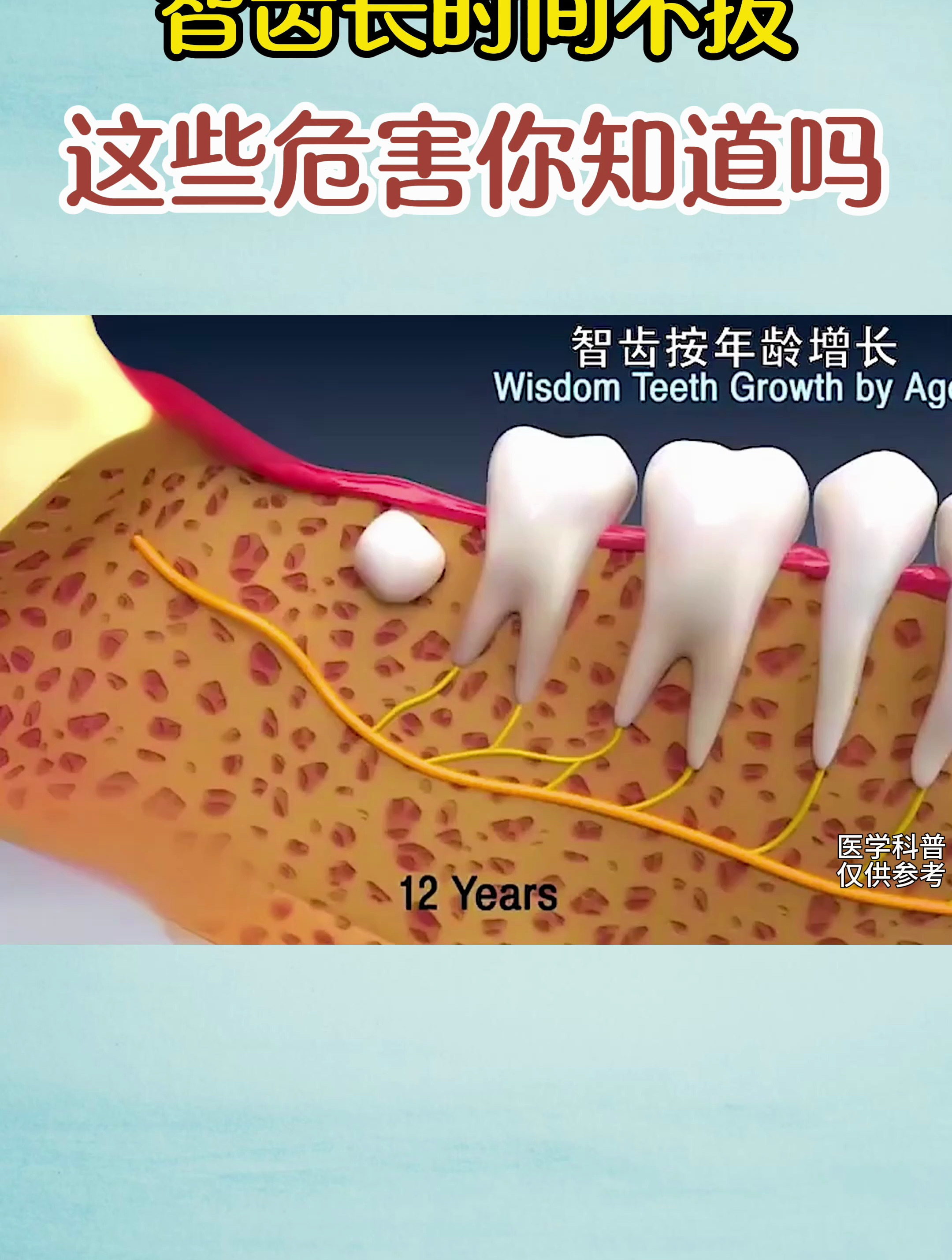 智齿长时间不拔这些危害你知道吗