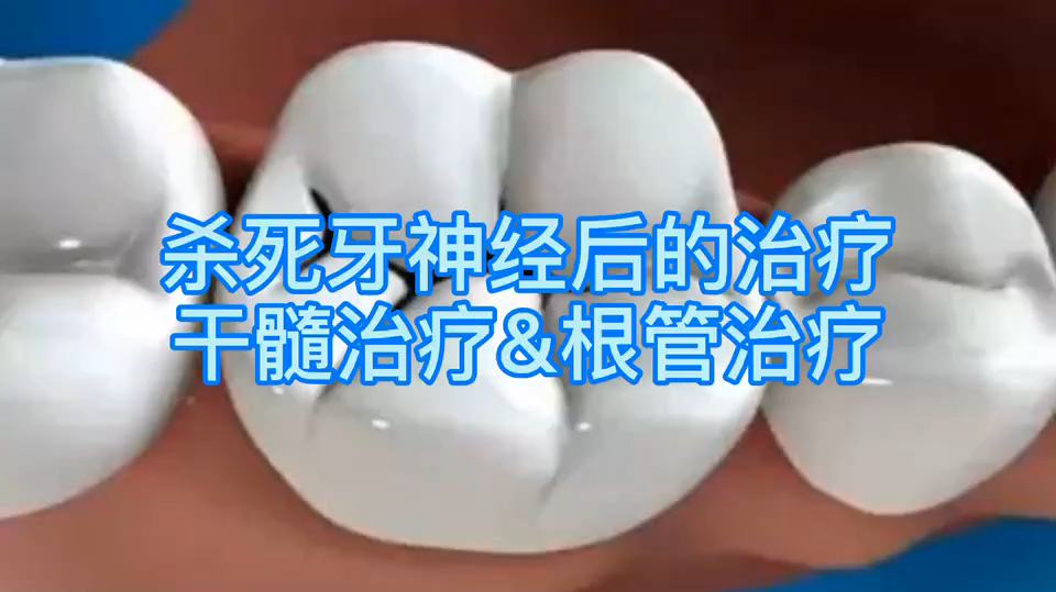 蛀牙打洞放药后的治疗有哪几种方法?分别是怎么样的?如何选呢?