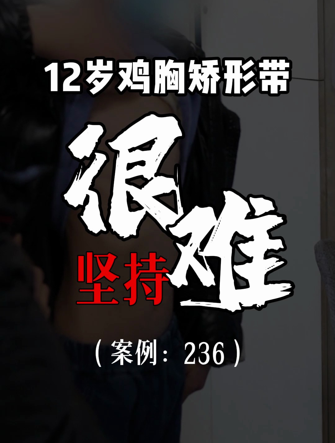 鸡胸的小朋友佩戴矫正带还是有机会纠正的