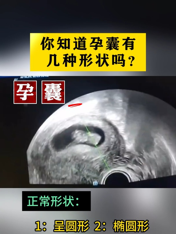 你知道孕囊有几种形状吗