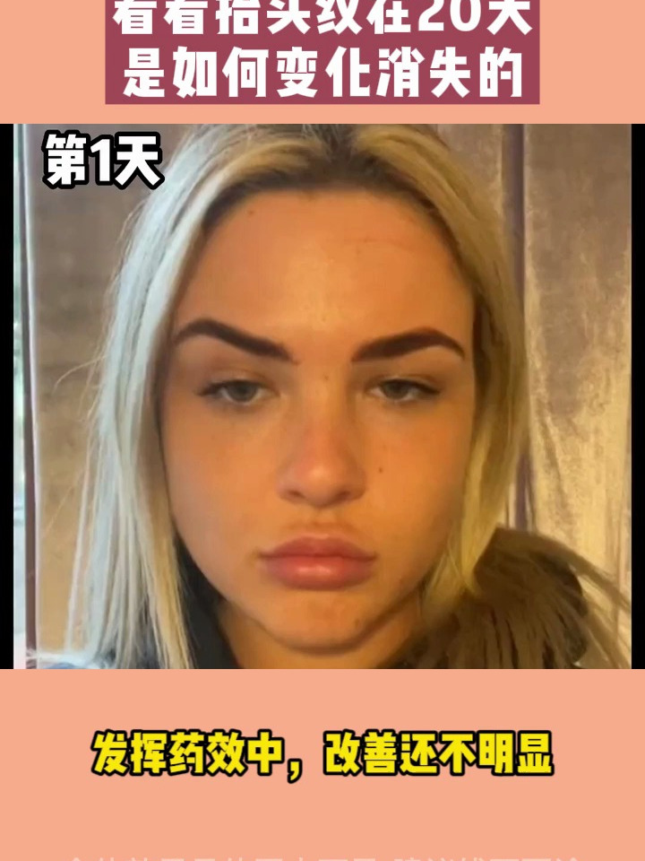 肉毒素除皱几天起效?带你看看20天的抬头纹变化!