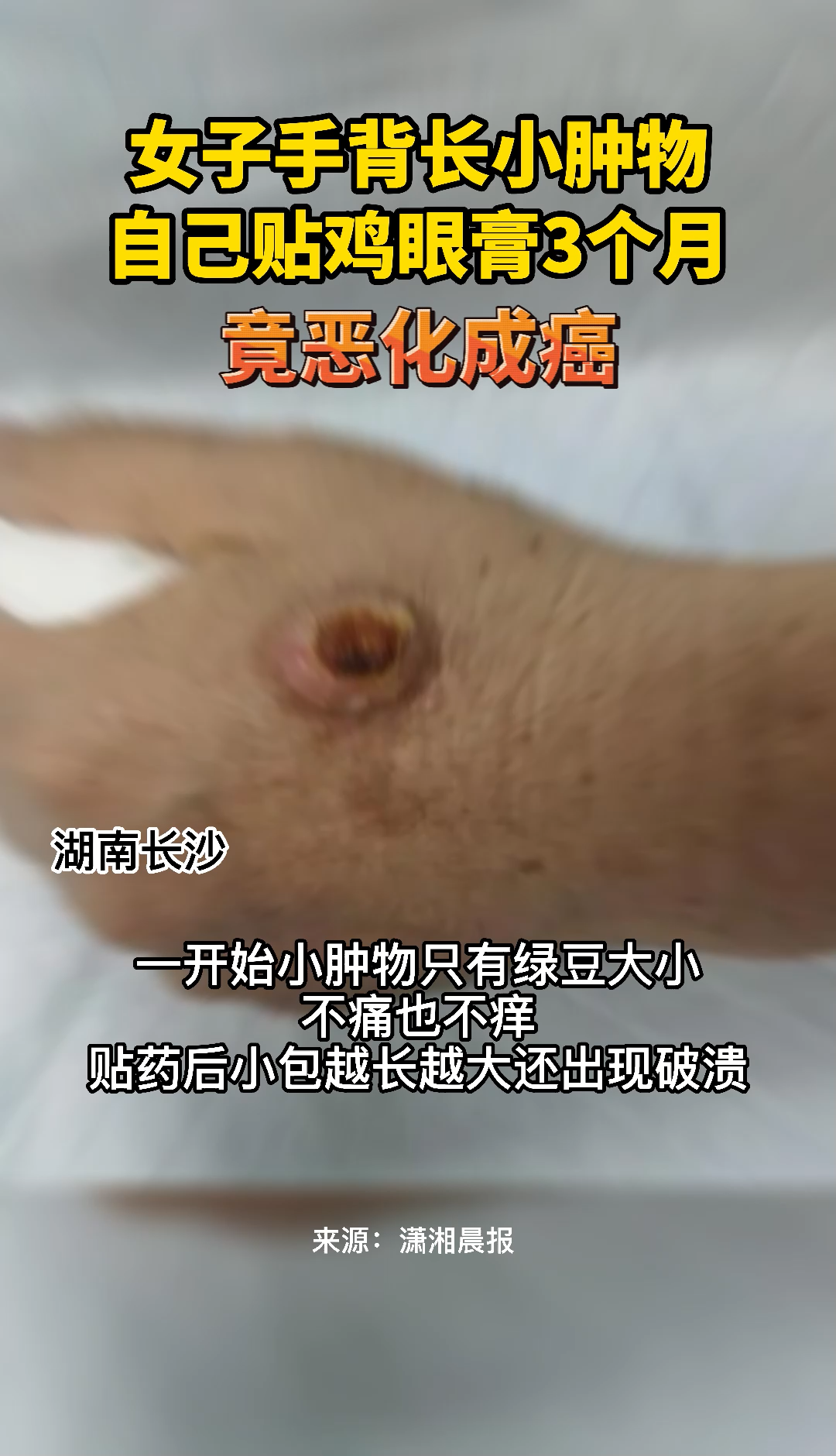 女子手背长小肿物,自己贴鸡眼膏三个月,竟恶化成癌!