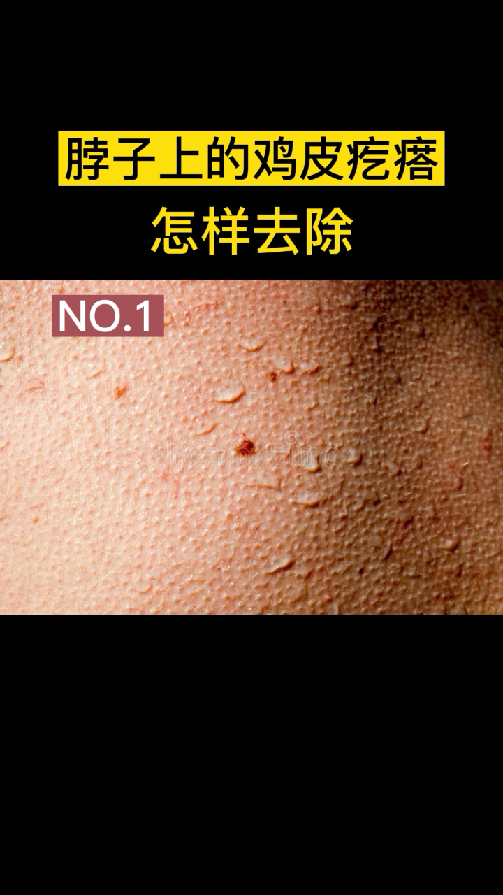 NO.1脖子上的鸡皮疙瘩怎么去除