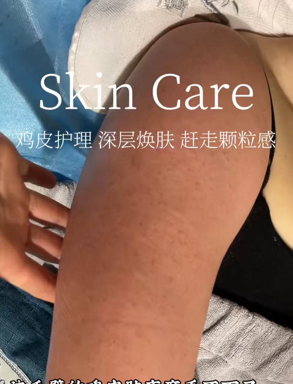 胳膊上鸡皮疙瘩太显眼，看着真不舒服！