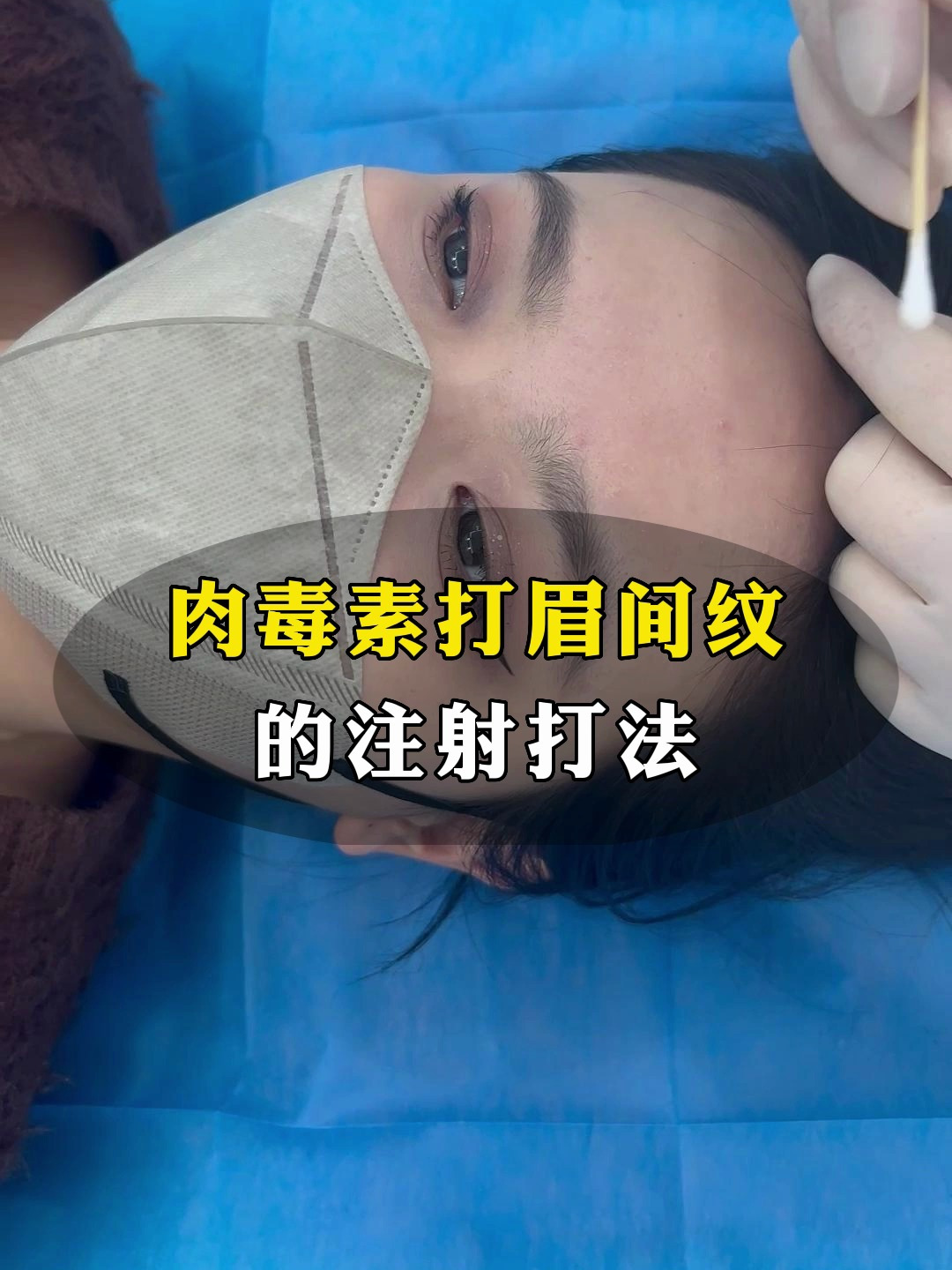 张瑛丽讲述肉毒素的注射方法