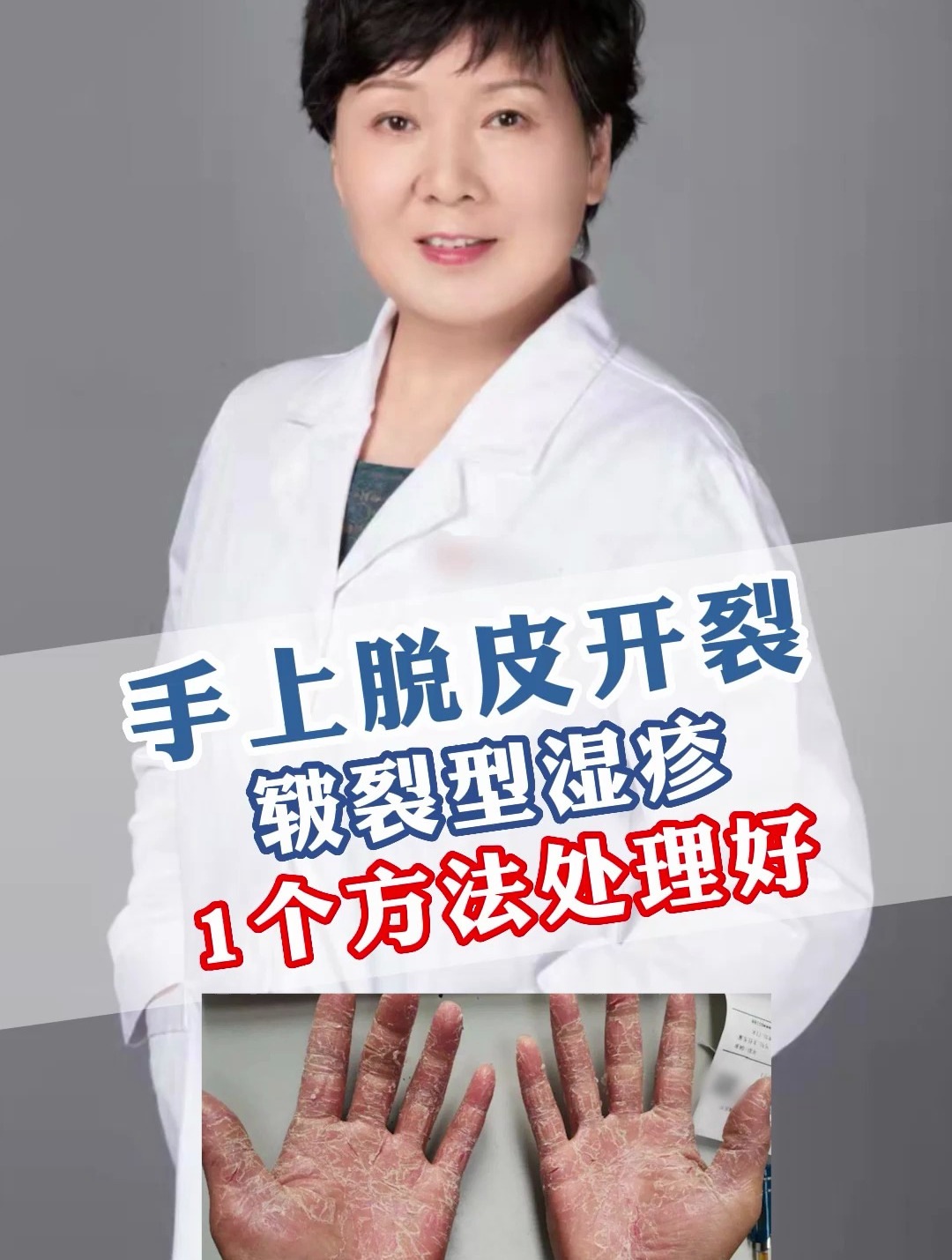 手上脱皮开裂,皲裂性湿疹,一个方法处理好!