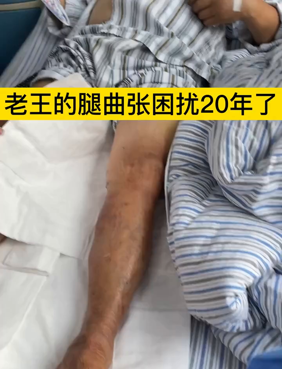 老王腿上青筋凸起20年，疼痛又难看！